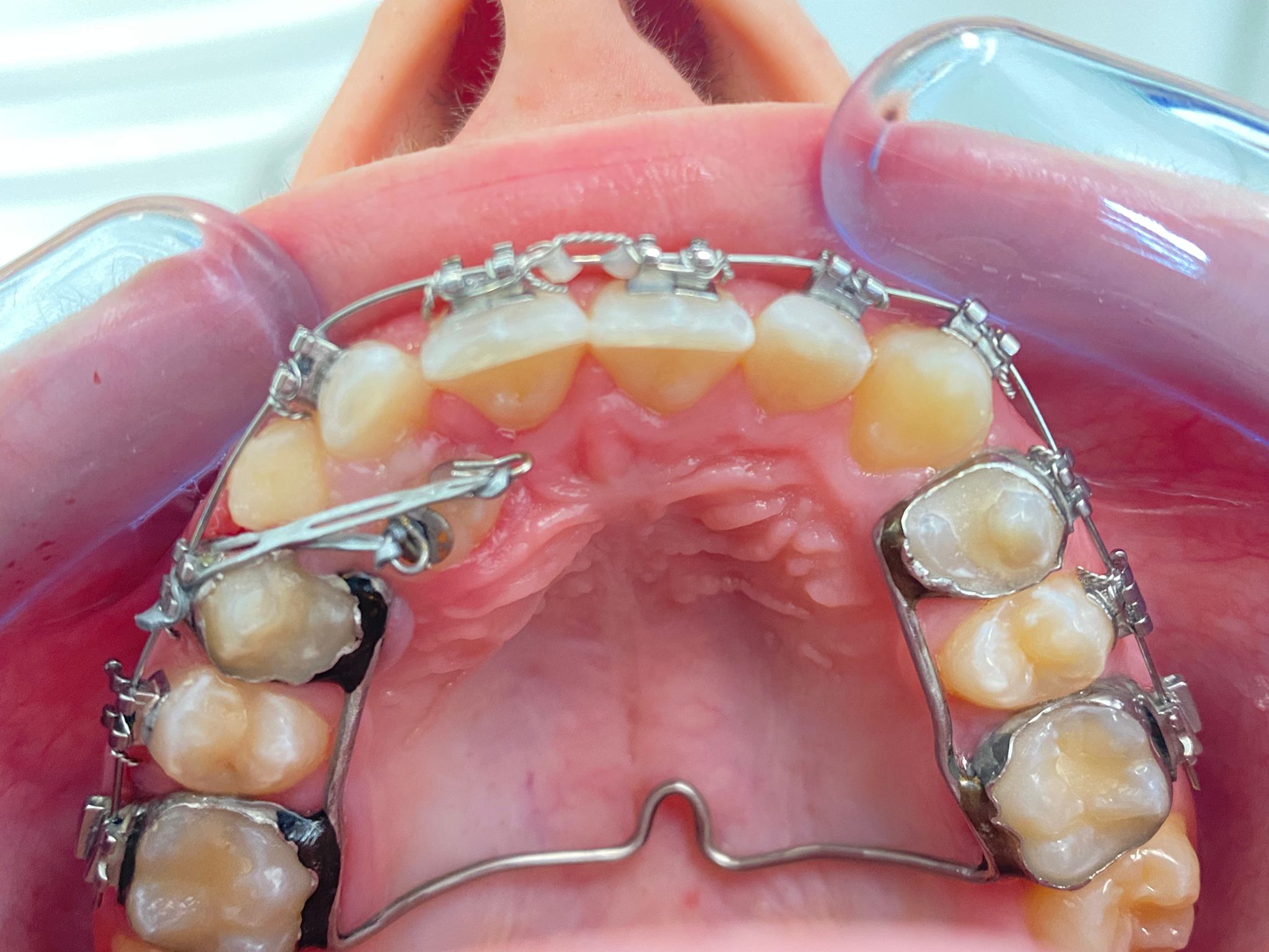 LA GESTIONE DELLO SPAZIO IN ORTODONZIA: agenesie, denti inclusi, anomalie sagittali e trasversali dei mascellari - 5 ECM