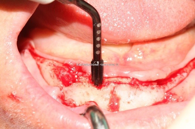 CORSO PRATICO DI CHIRURGIA IMPLANTARE (20 partecipanti)